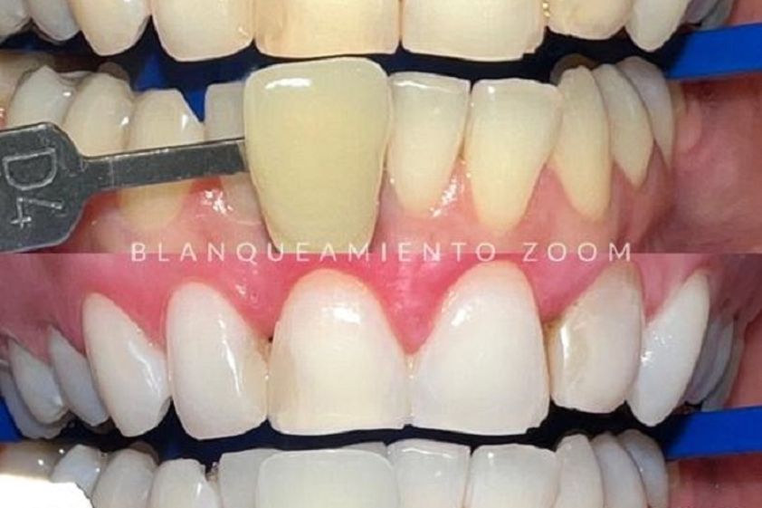 Blanquear dientes antes y después - 853116