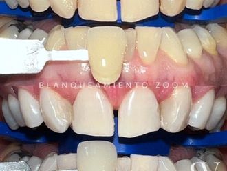 Blanquear dientes - 853117