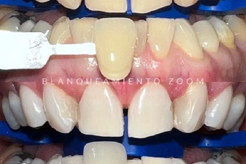 Blanquear dientes antes y después - 853117