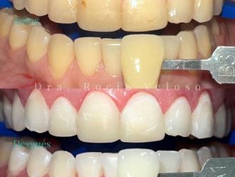 Blanquear dientes - 856709