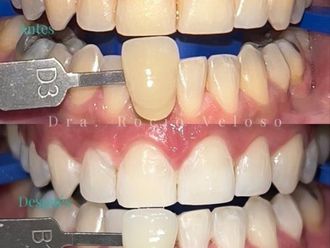 Blanquear dientes - 856711