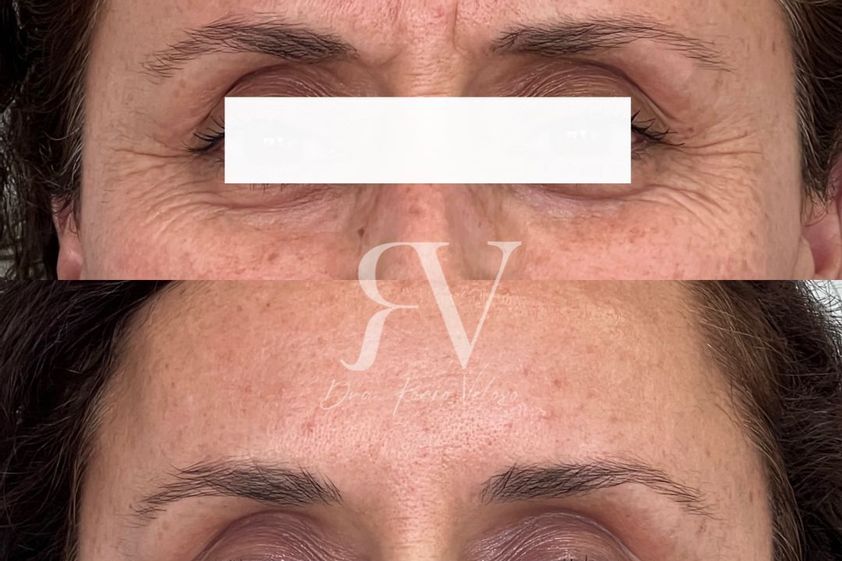 Bótox antes y después - 859563