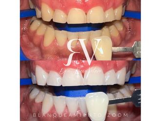 Blanquear dientes - 862710