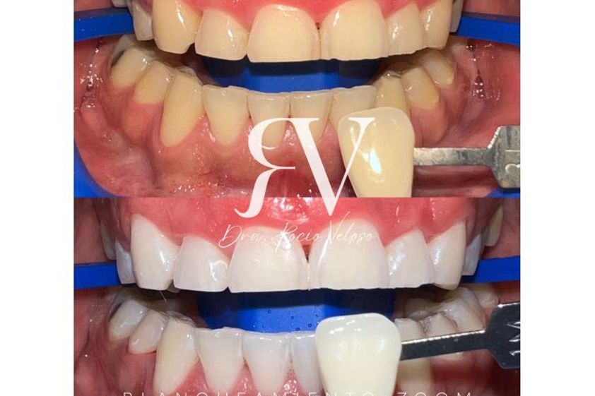 Blanquear dientes antes y después - 862710