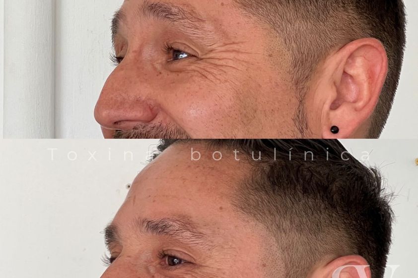 Bótox antes y después - 865777