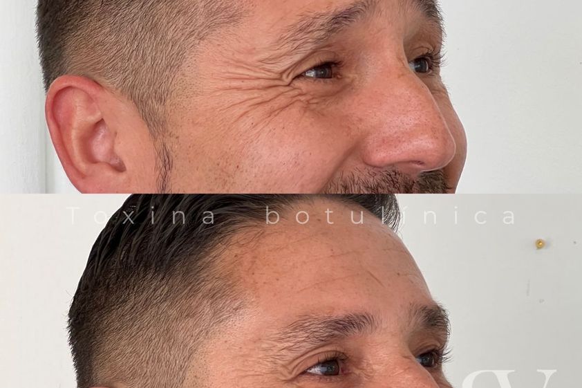 Bótox antes y después - 865778