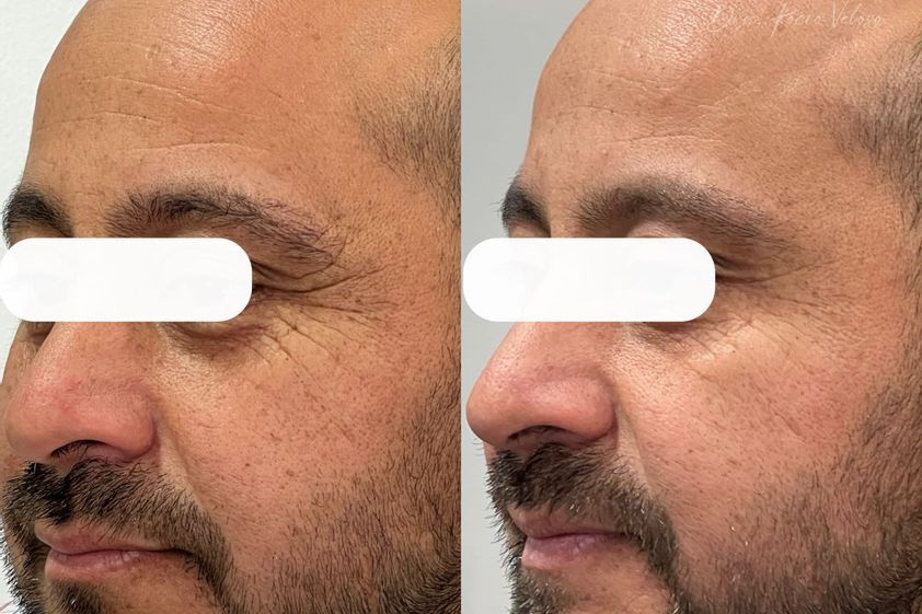 Bótox antes y después - 866945