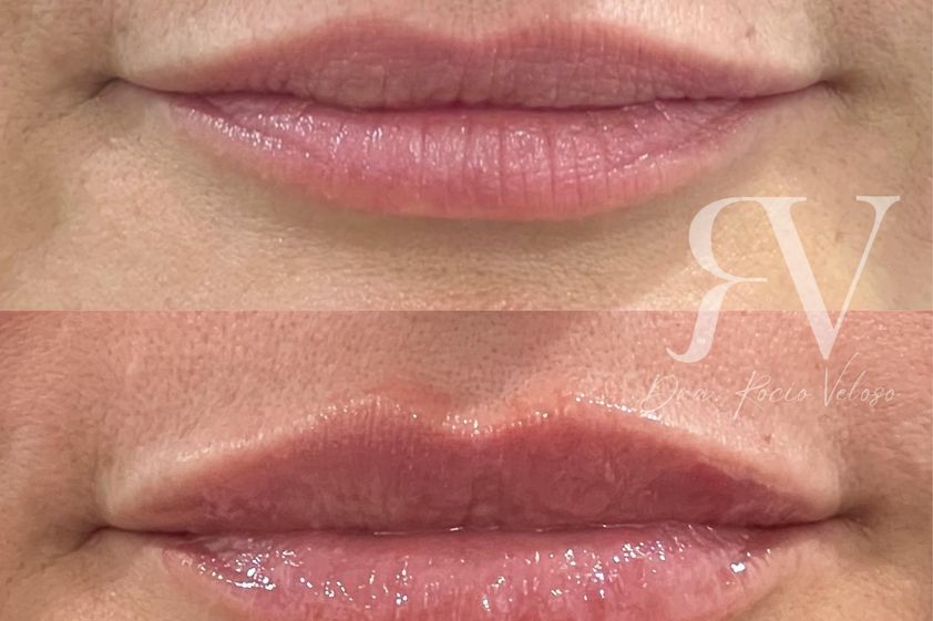 Aumento de labios antes y después - 869737