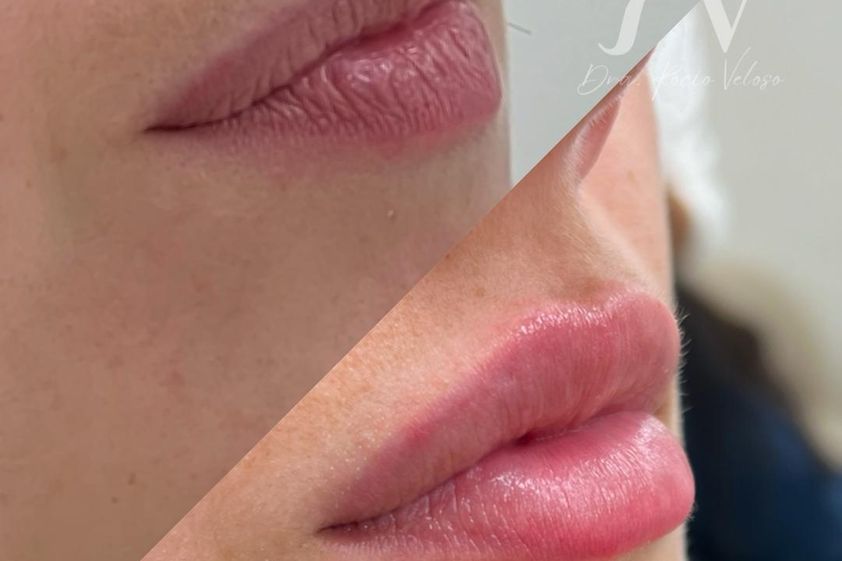 Aumento de labios antes y después - 872178