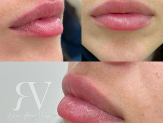 Aumento de labios antes y después - 872180