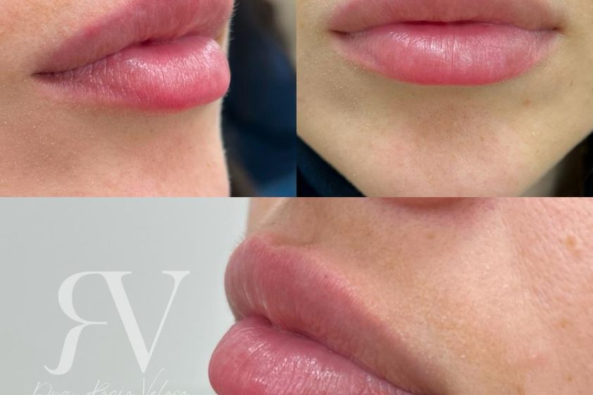 Aumento de labios antes y después - 872180