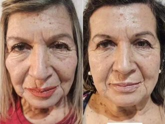 Rejuvenecimiento facial antes y después - 857375