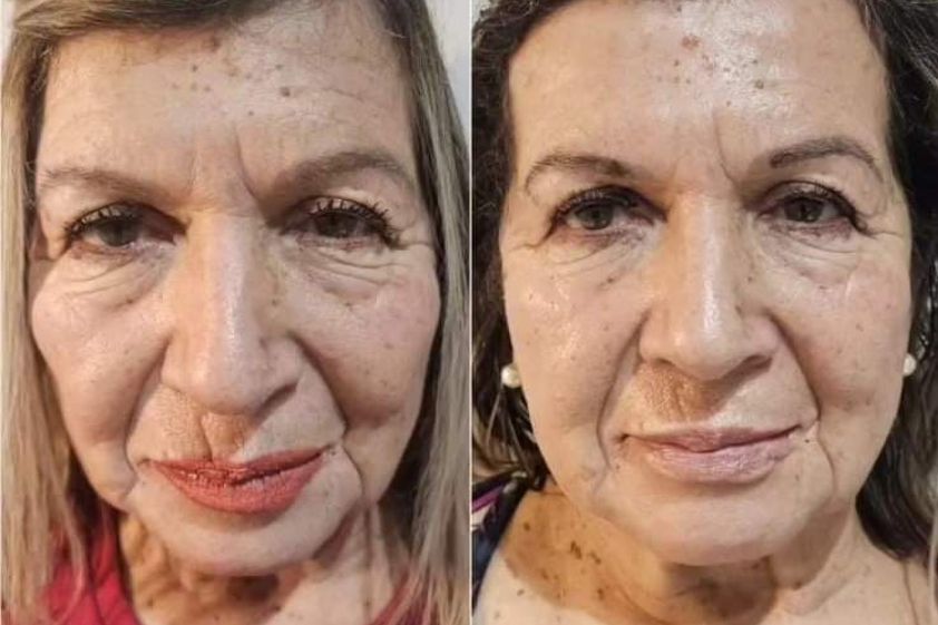 Rejuvenecimiento facial antes y después - 857375