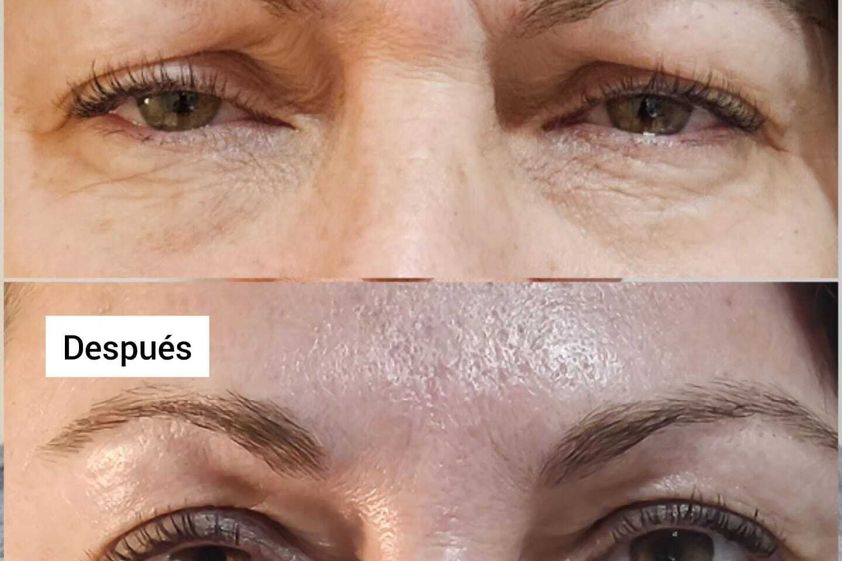 Bótox antes y después - 857378