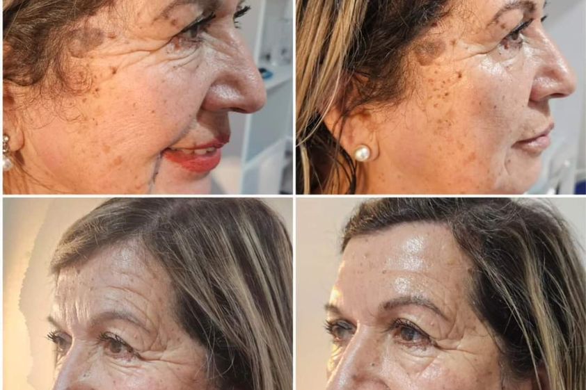 Rejuvenecimiento facial antes y después - 857384