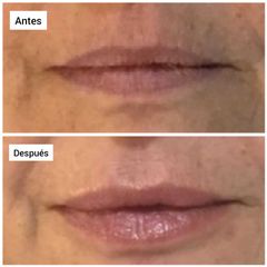Aumento de labios - Dr. Georg Hübner Arancibia