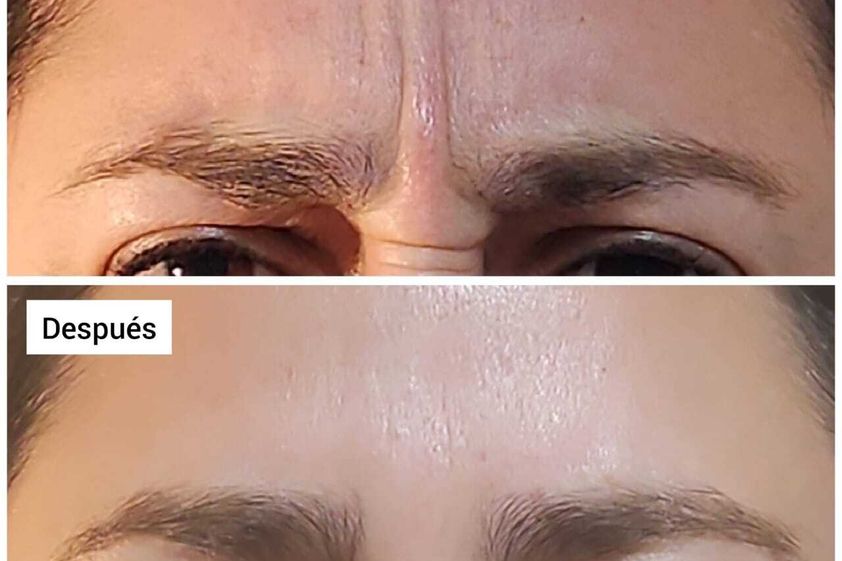 Bótox antes y después - 857912