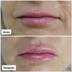 Aumento de labios - Dr. Georg Hübner Arancibia