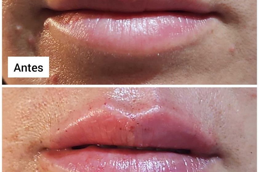 Aumento de labios antes y después - 858362