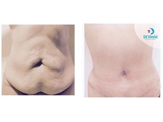 Abdominoplastía 