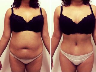  Abdominoplastia 