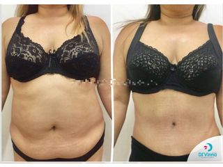 Abdominoplastia