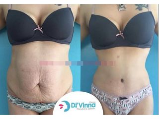 Abdominoplastia