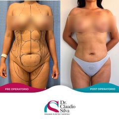 Lipoescultura - Dr. Claudio Silva Vergara