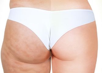 CARBOXITERAPIA