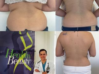 Hidrolipoclasia