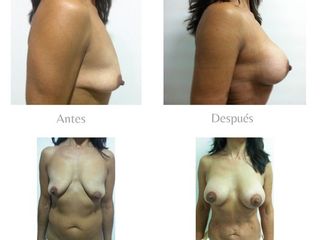 Lipo más aumento mamario