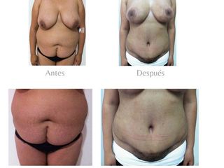 Abdominoplastia más pexia mamaria