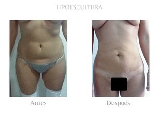 Lipoescultura
