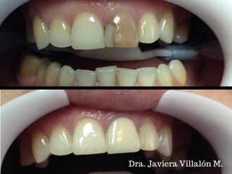 Carillas de porcelana - 620164