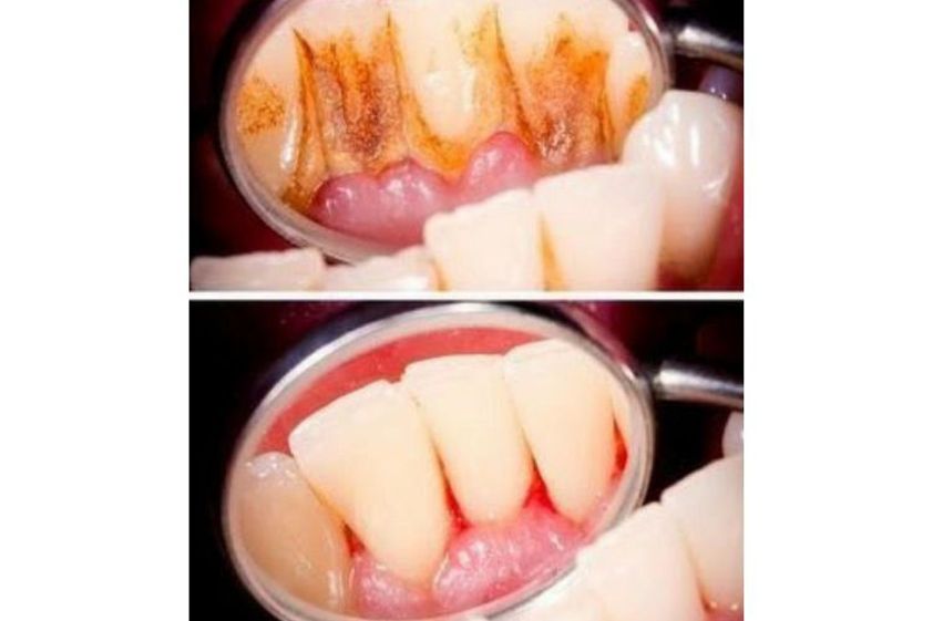 Limpieza dental antes y después - 792698