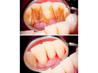 Limpieza dental - Dra. Javiera Villalón M. (Vitalzone)
