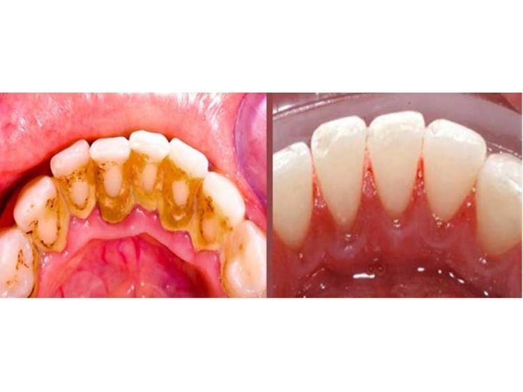 Limpieza dental Antes y después Clinicasesteticas.cl