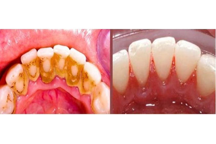 Limpieza dental antes y después - 792699