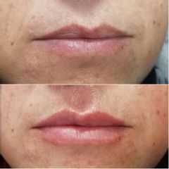 Aumento de labios - Dra. Javiera Villalón M. (Vitalzone)