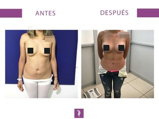 Lipoescultura con Implante Mamario