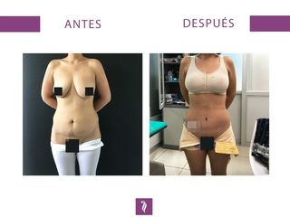Lipoescultura + Abdominoplastía + Implante Mamario