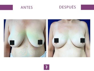 Aumento mamario - 633627