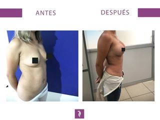Lipoescultura + Abdominoplastía
