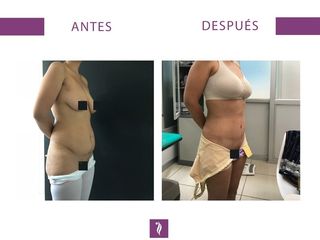 Lipoescultura + Abdominoplastía + Implante Mamario