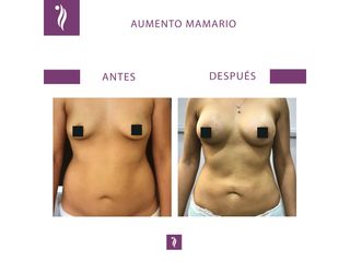 antes y despues aumento mamario 2