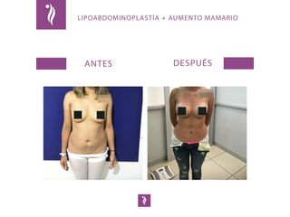 antes y despues aumento mamario1