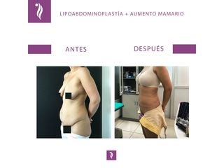 antes y despues lipo