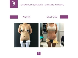 antes y despues lipo1