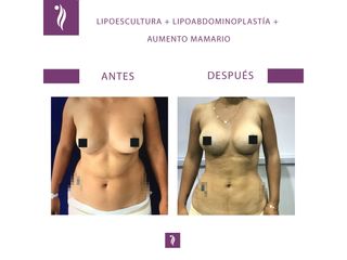 antes y despues lipoescultura