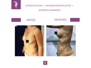 antes y despues lipoescultura1